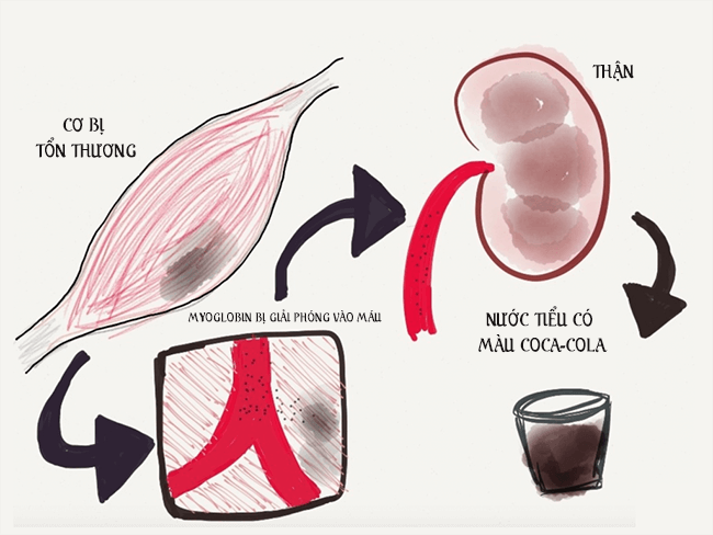 Biến chứng suy thận cấp do tiêu cơ vân 